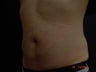 Coolsculpting Abdomen
