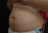 Coolsculpting Abdomen