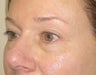 Lower lid fat prolapse, right worse than left. Loss of midface volume