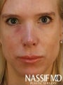 Female Revision Rhinoplasty