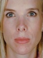 Female Revision Rhinoplasty