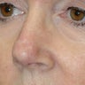 Nasal reconstruction after Mohs surgery