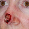 Nasal reconstruction after Mohs surgery