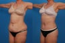 Lipo/Tummy Tuck: 59-Year-Old Woman