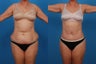 Lipo/Tummy Tuck: 59-Year-Old Woman