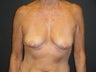 Breast reconstruction - tissue expanders
