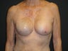 Breast reconstruction - tissue expanders