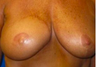 Breast Reconstruction
