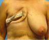 Breast Reconstruction