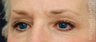 Eye Area Rejuvenation