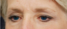 Eye Area Rejuvenation