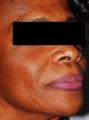 Female Patient Treated with Sculptra by Dr. Beverly Johnson in Washington, DC