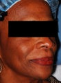 Female Patient Treated with Sculptra by Dr. Beverly Johnson in Washington, DC