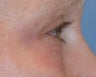 Laser Treatment of Lower Eyelid Wrinkles Performed