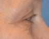 Laser Treatment of Lower Eyelid Wrinkles Performed