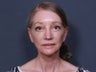 Neck Lift