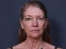 Neck Lift