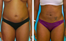 Liposuction Before & After