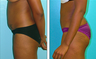 Liposuction Before & After