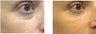 Treatment of Tear Troughs and Under Eye Circles with Restylane Filler