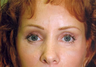 Forehead Lift