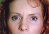 Forehead Lift