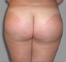 Female - Butt Augmentation
