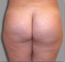 Female - Butt Augmentation