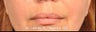 Lip Enhancement