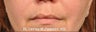 Lip Enhancement
