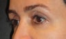 Restylane