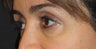 Restylane