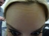 Botox- Forehead