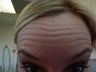 Botox- Forehead
