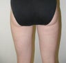 Liposuction