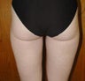 Liposuction
