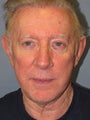 LiteLift™ and Brow Lift on 68-Year-Old Man