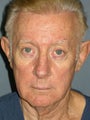 LiteLift™ and Brow Lift on 68-Year-Old Man