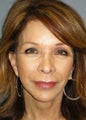 LiteLift™ on 59-year-old Woman