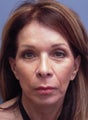 LiteLift™ on 59-year-old Woman