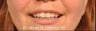 Lip Enhancement