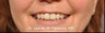 Lip Enhancement