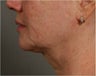 57 year old female with jowls and neck laxity treated with Smart Lipo by Dr. Ran Rubinstein, Newburgh, NY