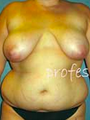 Breast Lift
