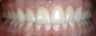 Band Burn from Orthodontics