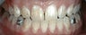 Band Burn from Orthodontics