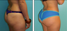 Brazilian Butt Lift Before & After