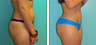 Brazilian Butt Lift Before & After