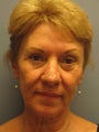 This 62-year-old woman had a LiteLift™, Temple Lift, and Blue Peel®