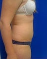 Laser Lipo